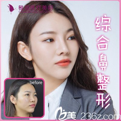 深圳雅涵高山做的膨體隆鼻案例對比圖