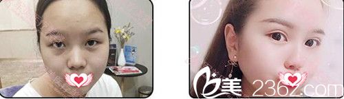廣州軍美整形雙眼皮案例效果對比 廣州軍美整形雙眼皮案例效果對比
