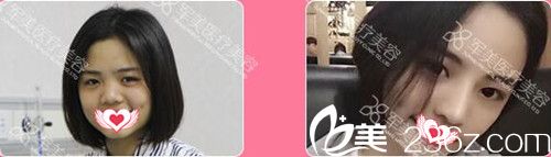 廣州軍美整形冀晨陽全肋骨隆鼻案例對比 廣州軍美整形冀晨陽全肋骨隆鼻案例對比