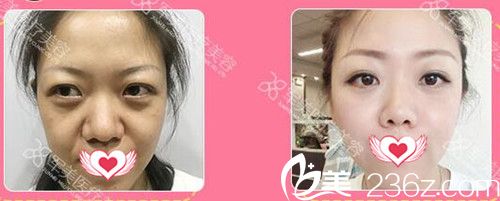 廣州軍美王世虎自體脂肪填充面部案例效果 廣州軍美王世虎自體脂肪填充面部案例效果