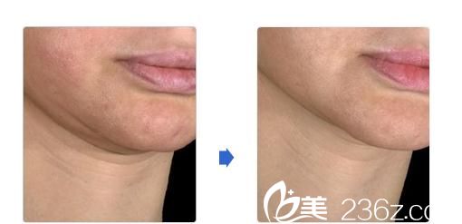 城野醫(yī)生醫(yī)療美容醫(yī)院Ulthera 照射治療 城野醫(yī)生醫(yī)療美容醫(yī)院Ulthera 照射治療