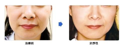 城野醫(yī)生醫(yī)療美容醫(yī)院熱瑪吉緊膚除皺 城野醫(yī)生醫(yī)療美容醫(yī)院熱瑪吉緊膚除皺