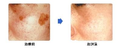 城野醫(yī)生醫(yī)療美容醫(yī)院激光祛斑 城野醫(yī)生醫(yī)療美容醫(yī)院激光祛斑