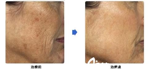 城野親德激光除皺 城野親德激光除皺