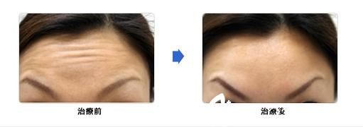 城野親德瘦臉除皺注射 城野親德瘦臉除皺注射