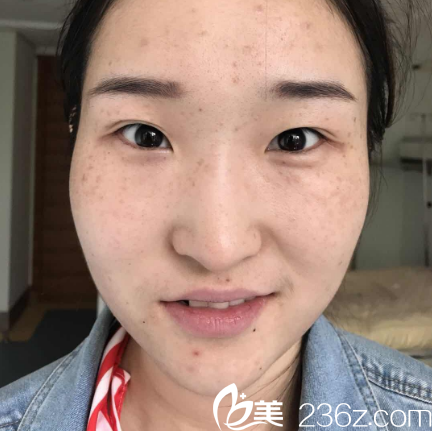 雙眼皮修復(fù)術(shù)前