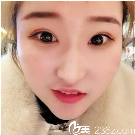 在北京馭美客四季青分院做完眼修復(fù)5天