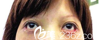 下瞼外翻眼袋修復(fù)