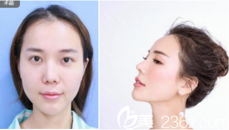 李德慶醫(yī)生鼻修復(fù)案例