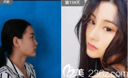 李德慶醫(yī)生網(wǎng)紅鼻案例