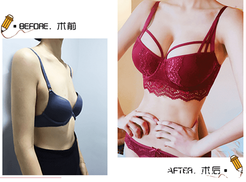 北京玲瓏梵宮假體隆胸多少錢？WNS雙平面動(dòng)感假體隆胸價(jià)格及范元濤案例來參考