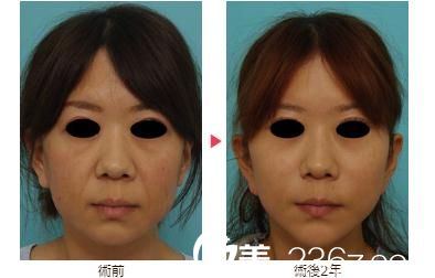 八事石坂美容外科醫(yī)院面部拉皮 八事石坂美容外科醫(yī)院面部拉皮