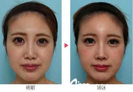 八事石坂美容外科醫(yī)院綜合隆鼻 八事石坂美容外科醫(yī)院綜合隆鼻