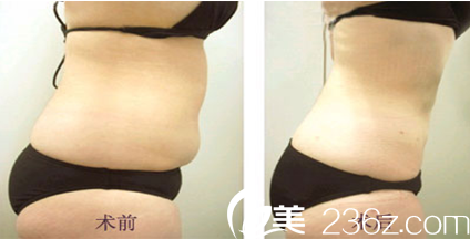 腰腹部抽脂手術前后對比