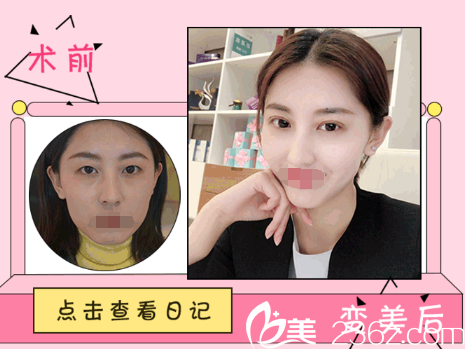 蘇州紫馨雙眼皮案例