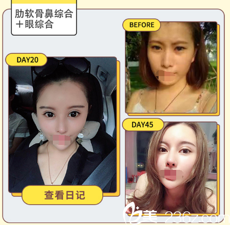 肋軟骨鼻綜合+雙眼皮案例