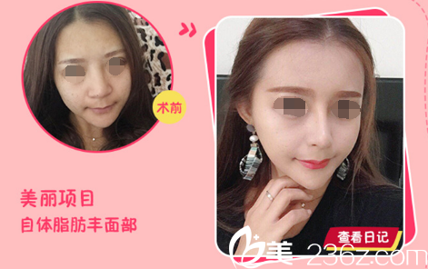 面部脂肪填充案例