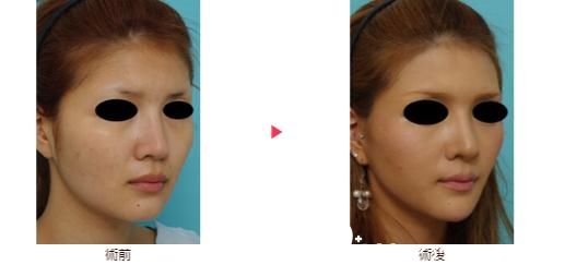 大口春雄面部拉皮