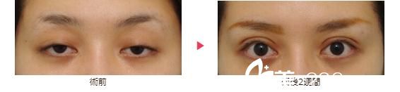 大口春雄眼瞼下垂修正