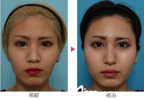 大口春雄綜合隆鼻術(shù)