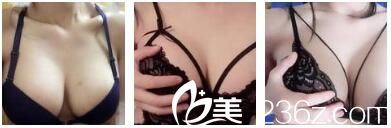 恢復(fù)過(guò)程中的自體脂肪豐胸術(shù)