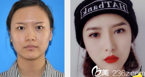 蘭州亞韓謝雯急速納米雙眼皮+耳軟骨綜合隆鼻效果圖 蘭州亞韓謝雯急速納米雙眼皮+耳軟骨綜合隆鼻效果圖