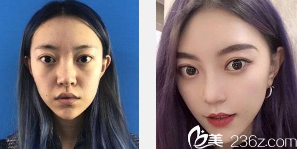 蘭州亞韓玻尿酸去除法令紋效果 蘭州亞韓玻尿酸去除法令紋效果