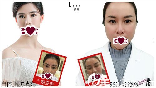 汕頭曙光整形醫(yī)院自體脂肪填充及線雕逆齡案例效果 汕頭曙光整形醫(yī)院自體脂肪填充及線雕逆齡案例效果