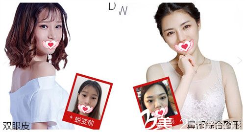 汕頭曙光整形雙眼皮及隆鼻案例效果對比 汕頭曙光整形雙眼皮及隆鼻案例效果對比