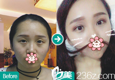 成都西區(qū)醫(yī)院整形科雙眼皮效果