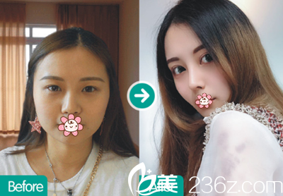 成都西區(qū)醫(yī)院整形隆鼻術(shù)后效果