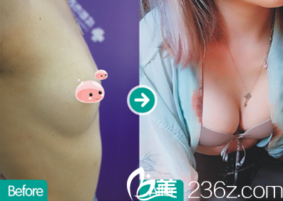 成都西區(qū)醫(yī)院整形科自體脂肪豐胸