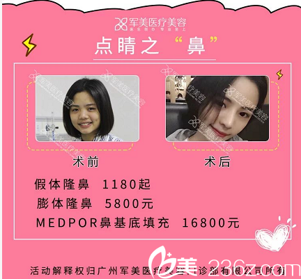 廣州軍美王世虎隆鼻案例價(jià)格表 廣州軍美王世虎隆鼻案例價(jià)格表