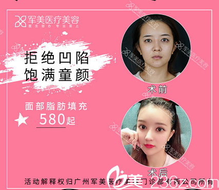 廣州軍美王世虎脂肪填充案例和價(jià)格單 廣州軍美王世虎脂肪填充案例和價(jià)格單