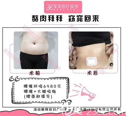 廣州軍美王世虎吸脂案例價(jià)格表 廣州軍美王世虎吸脂案例價(jià)格表