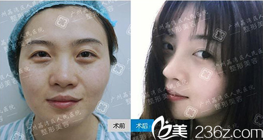 我在廣州荔灣區(qū)醫(yī)院整形美容做鼻綜合前后對(duì)比照片