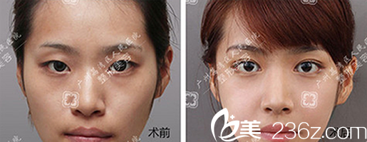 在廣州荔灣區(qū)醫(yī)院整形美容做完眼綜合效果圖