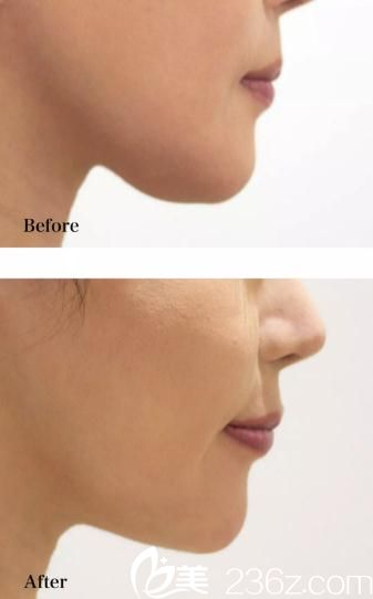 院長渡邊裕之 下巴削骨 院長渡邊裕之 下巴削骨