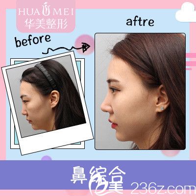 汕頭華美張?？龅碾p眼皮隆鼻案例