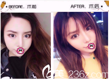 北京玲瓏梵宮面部吸脂特惠價(jià)及案例搶先看！還有王光輝黃海濱醫(yī)生坐診