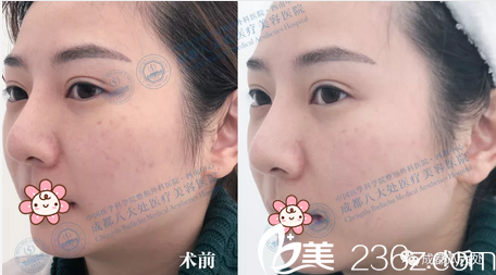 馮永強(qiáng)BBL美膚治療案例 馮永強(qiáng)BBL美膚治療案例