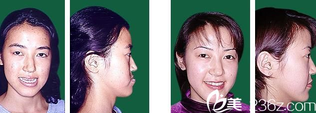 鶴木<!--<i data=20240703-sp></i>-->歯科醫(yī)院鄂變形治療 鶴木<!--<i data=20240703-sp></i>-->歯科醫(yī)院鄂變形治療