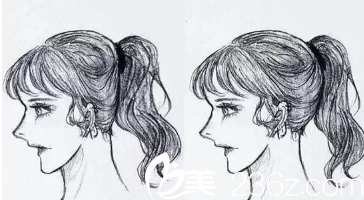 后腦勺整形漫畫(huà)圖 后腦勺整形漫畫(huà)圖