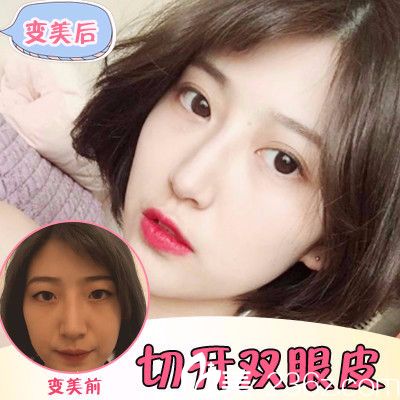 汕頭名流圣誕節(jié)優(yōu)惠整形價格表 雙眼皮1280元,隆鼻3980元,線雕6800元