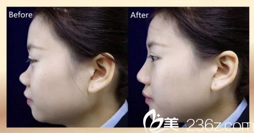 婁底德美玻尿酸注射隆鼻案例對比圖