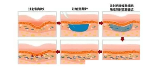  第2階段 （膠原蛋白形成階段）