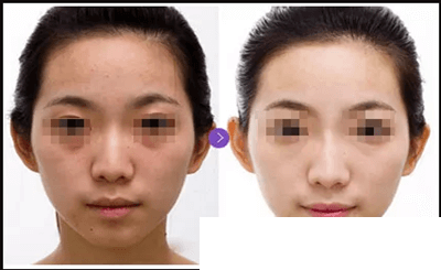 童顏水凝效果案例展示