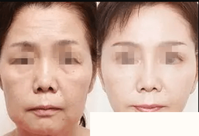 童顏水凝效果案例展示