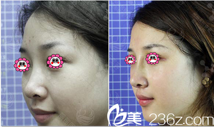 北京米蘭柏羽麗都吳玉家隆鼻實(shí)例