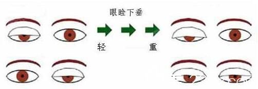 重慶時光整形美容醫(yī)院張建文上瞼下垂矯正的方法